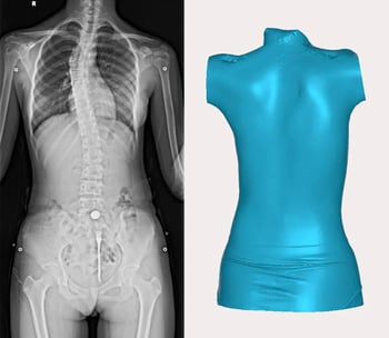 ScanTech iReal 3D Scan Spinal Orthopaedics